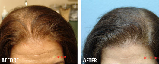 Female Hair Loss Before and After - Sacramento, CA