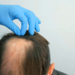 FUE Hair Transplant