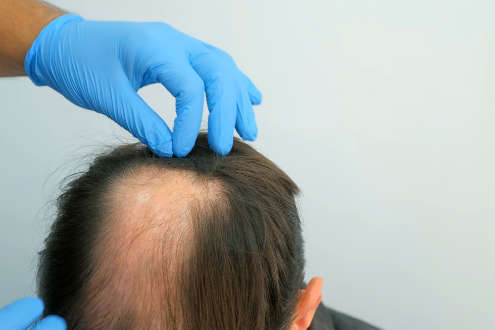 FUE Hair Transplant